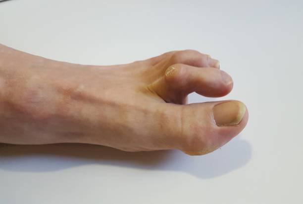 Ayak Çekiç Parmak Ameliyatı Nedir?