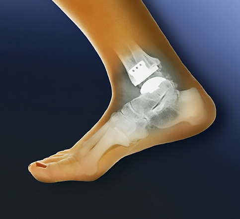 ayak bileği protezi cerrahis